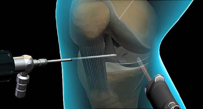 knee arthroscopy