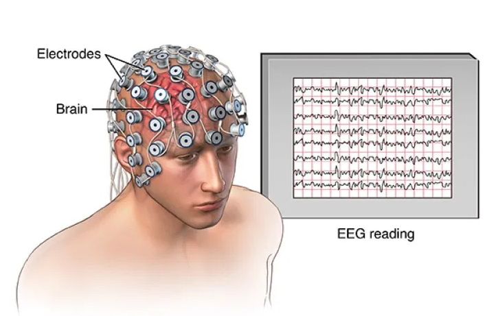 Electroencephalogram Eeg Uses Procedure Results