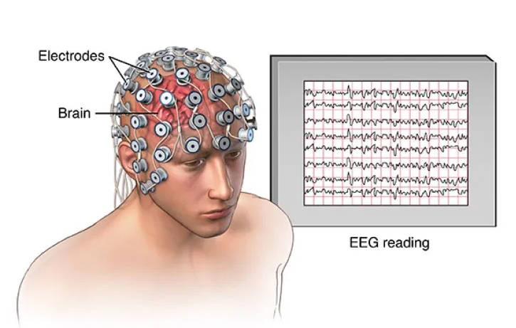 Eeg Test Results