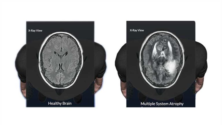 Multiple System Atrophy (MSA) | Symptoms, Causes, Diagnosis & Treatment