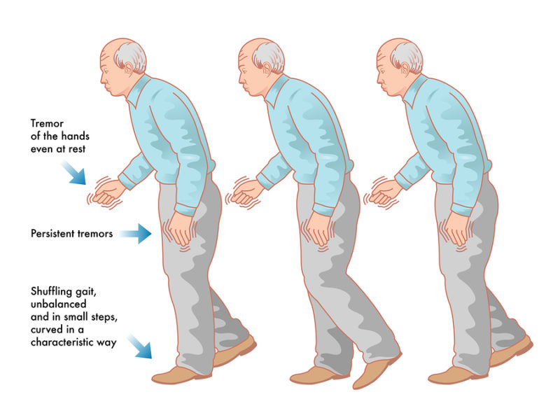 Parkinson's Disease | Symptoms, Causes, Diagnosis & Treatment | Dr ...